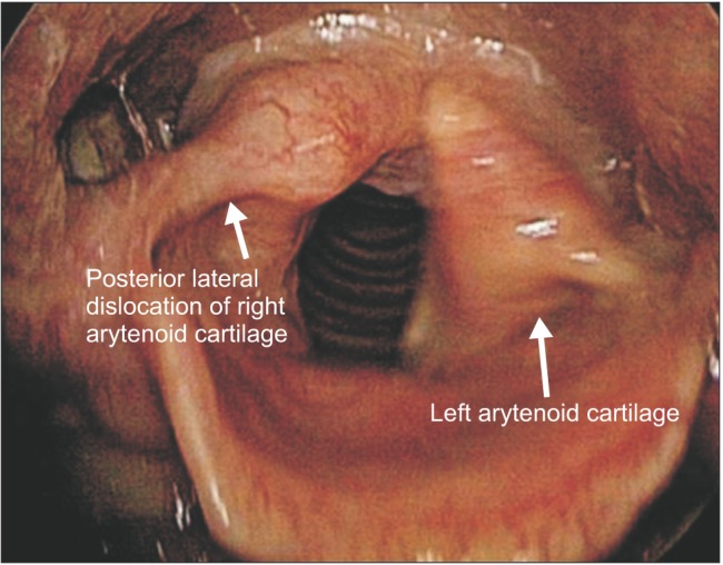 arytenoid cartilage intubation